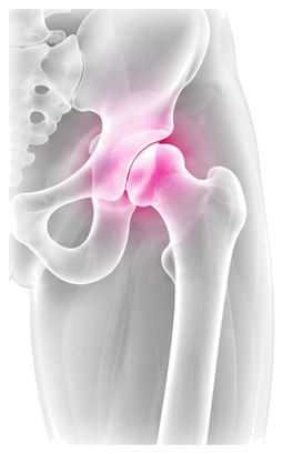 X-ray style view of the hip